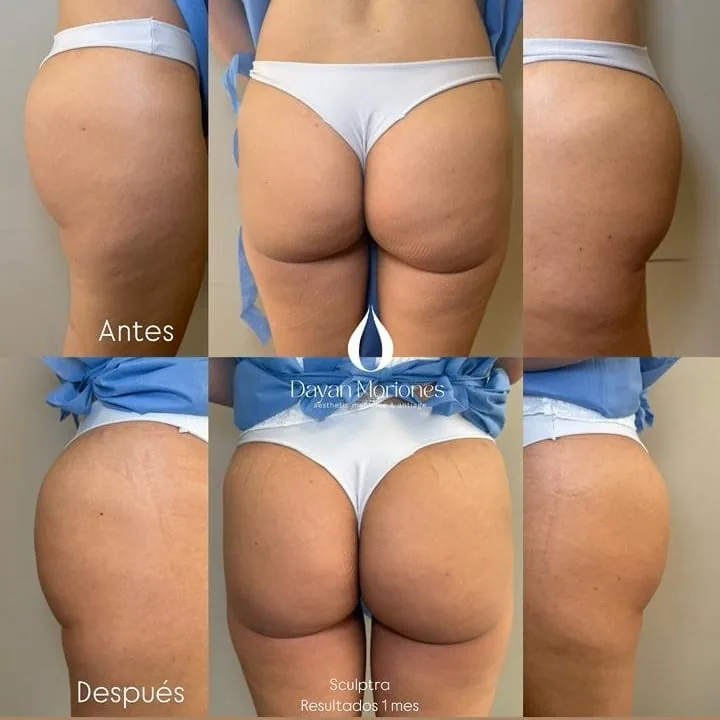 Comparación antes y después desde tres ángulos, tras tratamiento con bioestimulador con un mes de evolución