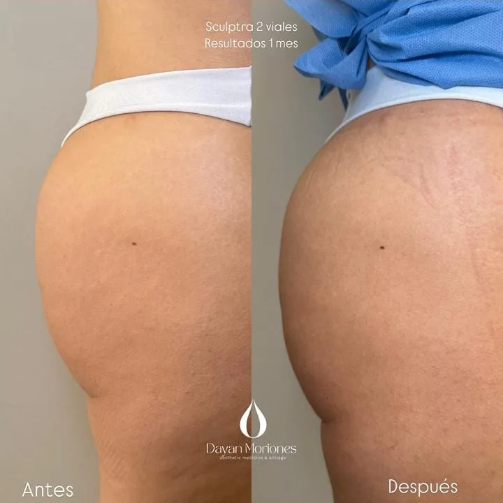Comparación antes y después de perfil, tras dos viales de bioestimulador con un mes de evolución